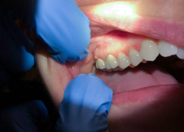 Best Emergency Broken Tooth Repair in Presque Isle, ME